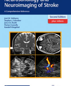 Neurosonology and Neuroimaging of Stroke, A Comprehensive Reference 2nd Edition - Original PDF